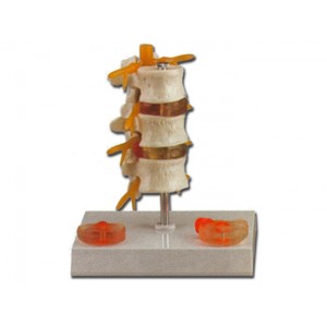 PATHOLOGIE  HERNIE
