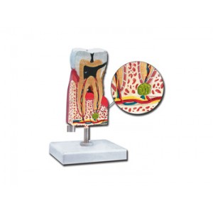MOLAIRE  INFERIEURE  AVEC  CARIES
